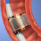 Эндоскопическая электропорация устраняет потребность в инсулине при СД 2 типа