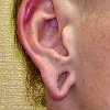Коррекция мочки уха
